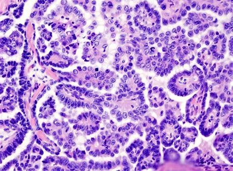 CancerRes：新研究发现帮助清除癌症干细胞的新靶标
